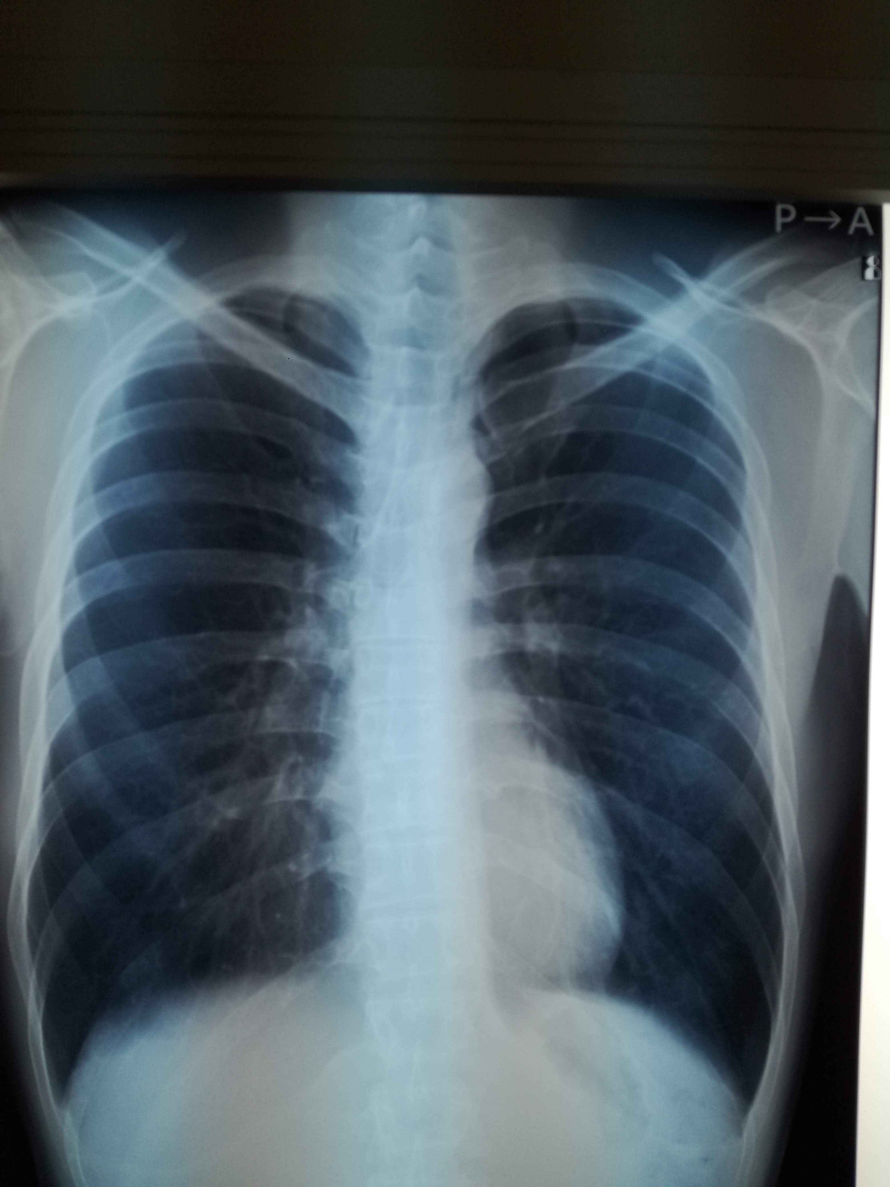 二、肺良性肿瘤-胸部CT-医学